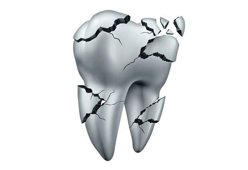 Illustration of cracked tooth