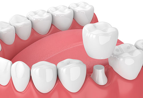 Dental crown illustration
