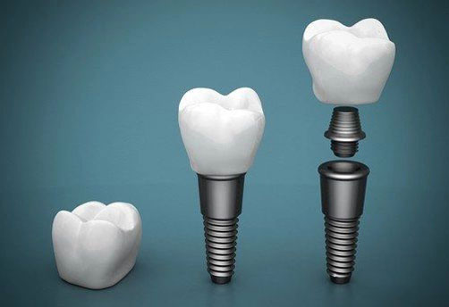 Dental implant types
